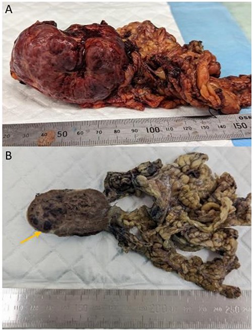 Gross appearance of the tumour consistent with littoral cell angioma. (A) Fresh pathology specimen of singular tumour from left upper quadrant with omentum attached, estimated length: 70 mm. (B) Specimen post fixation of cut surface, evidence of pools of blood (arrow).
