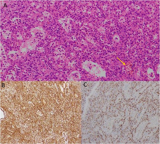 Histological images of the resected mass, showing evidence of littoral cell angioma. (A) Histology slide x200 magnification: multiple vascular channels lined by cells with reactive endothelium. There is focal haemorrhage (arrow). (B) Histology slide x100 magnification: staining positive for CD31. (C) Histology slide x200 magnification: staining positive for CD68.