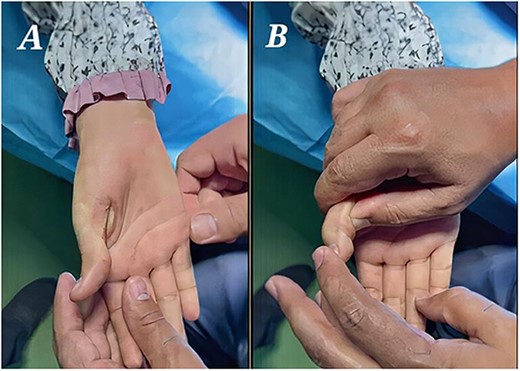 (A) Preoperative picture demonstrating an absence of flexion creases with normal thenar muscles. (B) Preoperative normal passive flexion.