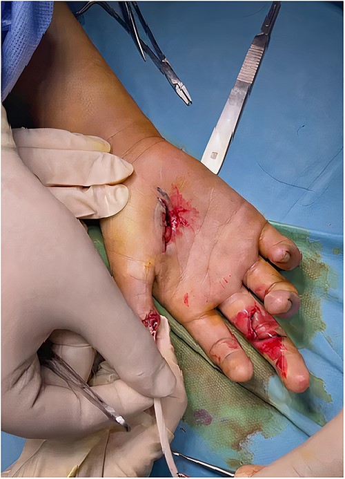 Intraoperative pictures of the second stage of surgery that included tendon transfer and silicon removal.