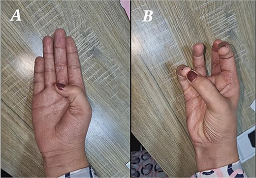 (A) Excellent post-operative flexion of the IPJ proximally 55°–70°. (B) Normal thumb opposition.