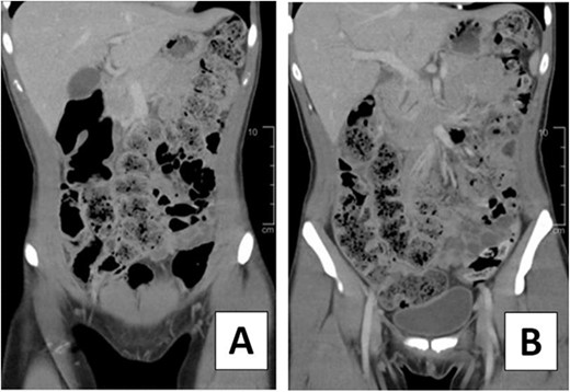 CT scan of 23-year-old female on hospital Day 1. (A, B) Coronal views depicting moderate to large fecal load.