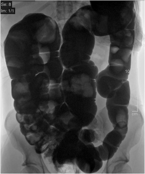 CT Diatrizoate meglumine (DM) enema with air contrast. DM flows in a retrograde manner from the rectum to the cecum without evidence of obstruction or mass.