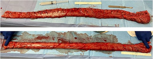 Intraoperative findings from hand-assisted laparoscopic extended right colectomy/subtotal colectomy with anastomosis. (Top) 80 cm (2.62 ft) resected segment of the dilated redundant ascending colon. (Bottom) 95 cm (3.12 ft) resected segment, on stretch.