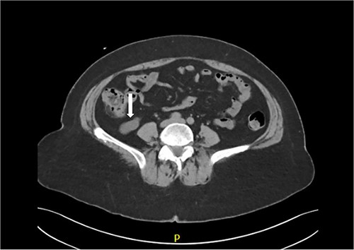 CT scan shows markedly dilated appendix consistent with mucocele.