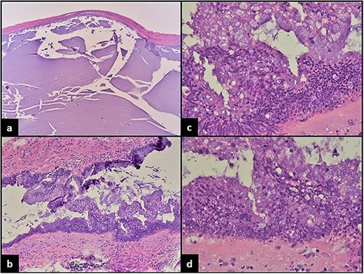 (a) Dilated appendix filled with mucinous material and mostly devoid of epithelial lining. (b) Focal areas show epithelial proliferation and piling up of cells forming vague papillary structures. (c) Marked convoluted architecture with focal cribriforming, epithelial proliferation and marked cytologic atypia. (d) High-grade dysplastic changes with nuclear stratification to the surface of the epithelium, large hyperchromatic pleomorphic nuclei and prominent mitosis.