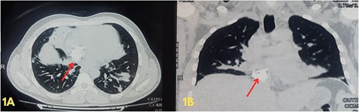 (A and B) Axial and coronal views of a high-resolution computed tomography scan of the chest showing multiple opacifications in the lung field and heavy calcification within the right atrium, extending up to the opening of the inferior vena cava.