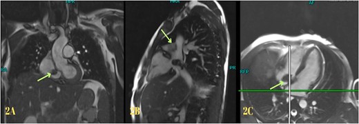 Cardiac magnetic resonance imaging showing myxoma.