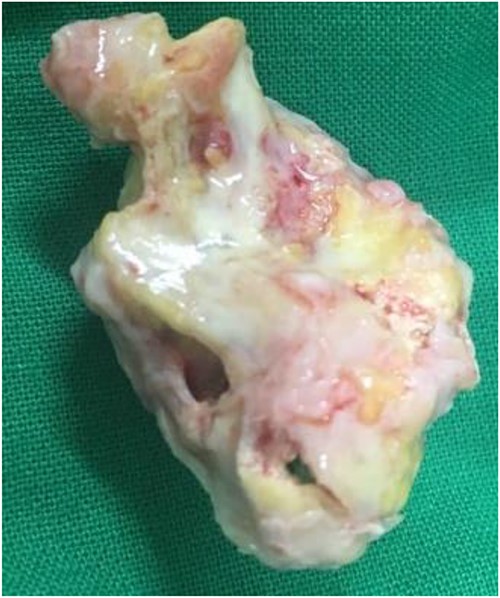 Gross morphology of the resected specimen.