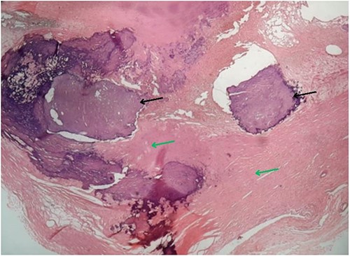 Microscopy of the resected specimen showing focal calcified (black arrow) and myxoid areas.