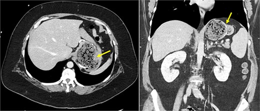 Cross-sectional CT imaging demonstrating concern for gastrogastric fistula.
