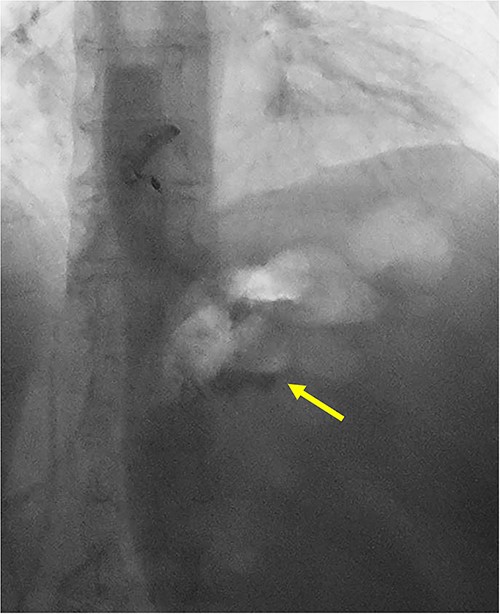 UGI series demonstrating passage of oral contrast from gastric pouch to remnant stomach.