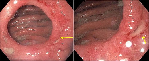 Pre-operative EGD demonstrating wide-mouthed gastrogastric fistula with an associated ulcer.