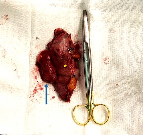 En-bloc resection of gastrogastric fistula with excised portions of gastric pouch (arrow) and gastric remnant (asterisks).