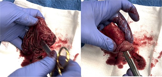 Scissors placed through gastrogastric fistula demonstrating complete resection of fistula.