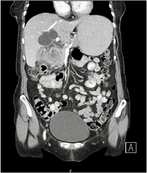 Coronal CT image of abdomen demonstrating fistulous connection between the gallbladder and duodenum and a large gallstone.