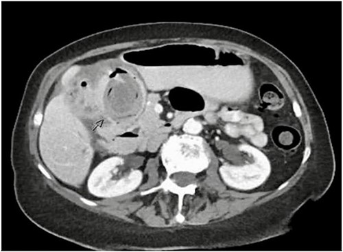 Axial CT image of abdomen demonstrating a fistulous connection between the gallbladder and duodenum and a large gallstone.