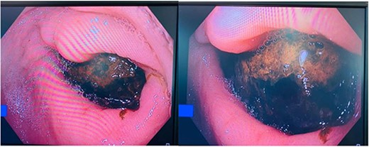 Large gallstone in pylorus side of the duodenum on endoscopy causing complete obstruction.