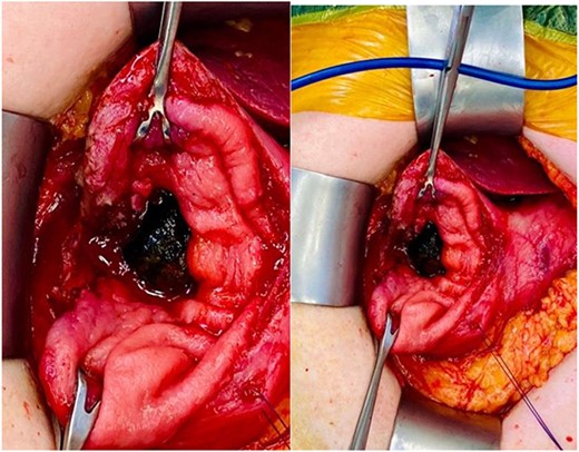 Mini laparotomy, gastrotomy, and extraction of large impacted gallstone causing gastric outlet obstruction.