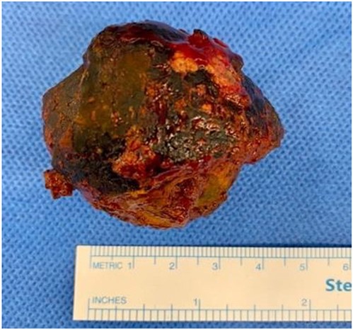 Large gallstone retrieved during laparotomy measuring up to 4 cm in diameter.