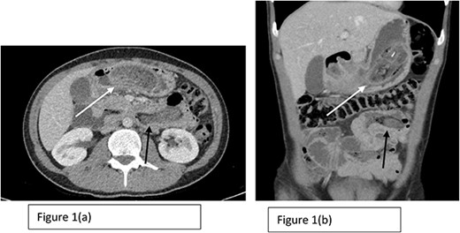 Axial (a) and coronal (b) sections of CT scan showing the presence of Trichobezoar in the stomach with extension into the small bowel (The white arrow in both Fig. 1a and b shows the trichobezoar in the stomach while the back arrow shows the extension into the small bowel with surrounding inflammation).