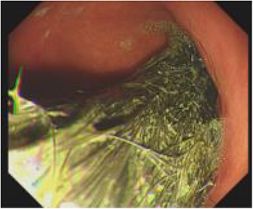 Gastroscopy image showing the presence of hair fibres forming the trichobezoar in the stomach.