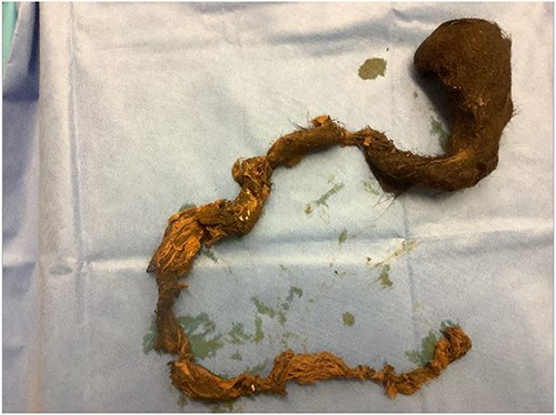 Trichobezoar specimen removed intact showing the outline of the stomach and extension into the small bowel.