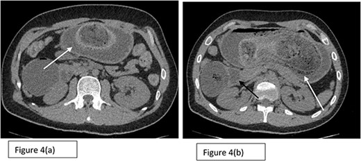 Axial sections (a) and (b) of CT scan showing the presence of Trichobezoar in the stomach (white arrows) with extension into the duodenum noted as well.