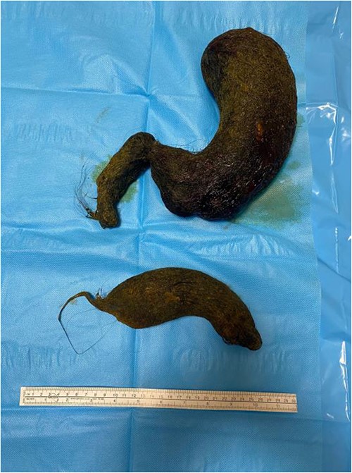 Trichobezoars removed from stomach and duodenum.