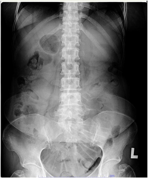 Abdominal x-ray showing a dilated small bowel with valvulae conniventes.