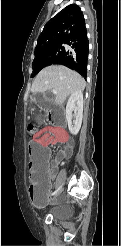 Sagittal view of CT scan. The involved bowel loops are thickened with mesenteric invagination into the intussusception. The distal small and large bowel appears collapsed.