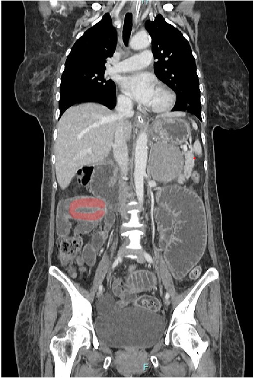 Coronal view of CT scan. Intussusception transition point is seen likely at the proximal ileum with evidence of ‘bowel in bowel’ appearance, measuring ~7.8 cm.