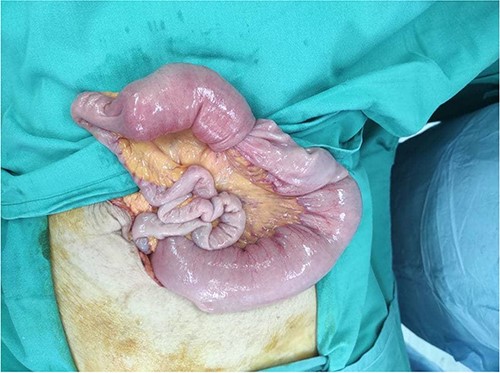 Small bowel noted to be grossly dilated proximal to the site of intussusception.
