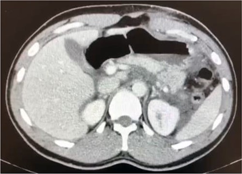 Transection of the pancreatic parenchyma throughout the distal body area (suggesting ductal damage) with a significant fluid collection.