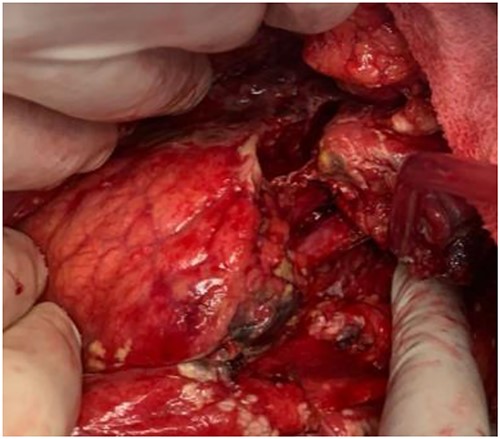 Pancreatic body complete transection (thick arrow—splenic artery; thin arrow—splenic vein).
