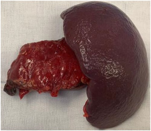 Distal pancreatectomy with en bloc splenectomy specimen.
