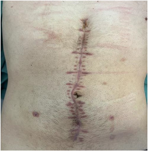 Patient abdominal wound—6 weeks after surgery.