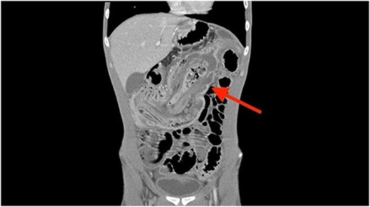 Coronal CT scan showing ileocolonic intussusception extending to the sigmoid colon.
