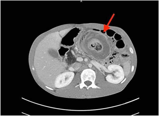 Axial CT scan showing characteristic target sign of bowel intussusception.