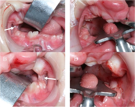 A, B: before release surgery, syngnathia is seen on both sides (white arrow); C, D: after surgery, syngnathia is released on both sides.