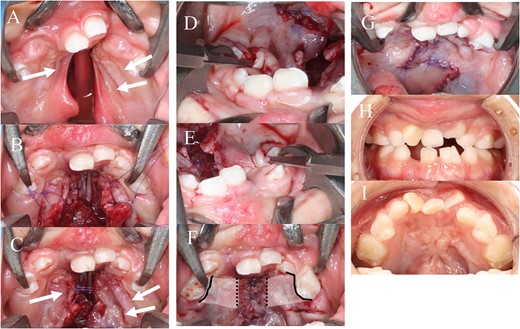 A: BCLP and short soft palate (white arrow: folded oral mucosa); B: after closure on the nasal side; C: the folded oral mucoperiosteum does not extend far enough to allow closure of the cleft palate and so is not closed directly; D, E: submucosal dissection with periosteotomy by a small blade from the cervical region of the teeth; F: the oral mucosa is closed after submucosal dissection; white area: range of submucosal dissection; black line: cervical incision; black dotted line: periosteotomy on the oral hard palate; G: after closure of the soft palate by DOZP; H, I: 6 years after surgery.