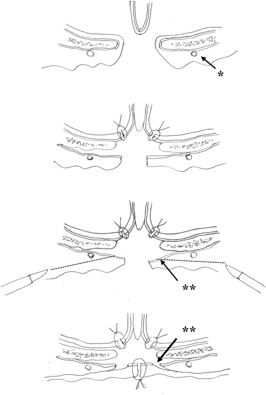 Illustration of the procedure on cross-section of the hard palate (arrowhead*: palatine artery; arrowhead**: periosteotomy; dotted line: submucosal dissection).