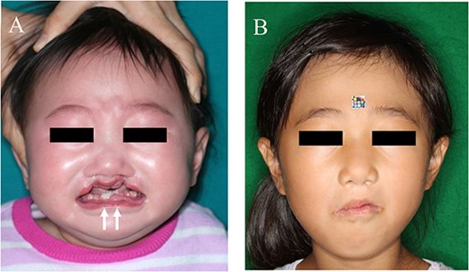 Facial appearance. A: preoperatively, the patient shows incomplete BCLP with fistulas of the lower lip (white arrows); B: 6 years after surgery.