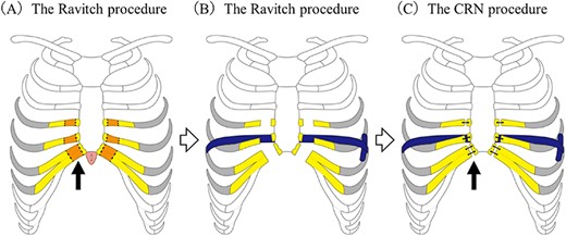 Operative technique for the combined Ravitch and Nuss procedure. (A) The Ravitch procedure. The deformed bilateral cartilages were transected from the third or fourth to the seventh costal cartilage junctions. (arrow) After these procedures, the recessed sternum could be easily raised. (B) The Nuss procedure. A titanium pectus bar was passed across the mediastinum under the transected sternum and rotated 180° to stabilize the anterior chest wall. (C) Final step. After the edge of the costal cartilage was trimmed, suturing to the edge of the costal cartilage and sternum was done using surgical wire or thread sutures (arrow).