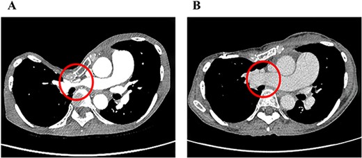 Pre- (A) and postoperative (B) chest CT findings of severe PE with stenosis of the right main pulmonary artery. The diameter of the right main pulmonary artery increased from 5 to 20 mm after the CRN procedure.