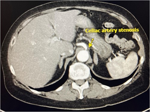 CT Angiography demonstrating celiac artery stenosis close to its origin.
