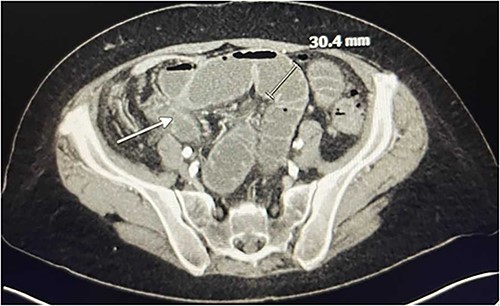 CT Angiography showing SBO with transition point in the right lower quadrant. A loop of thickened ileum measures 30.4 mm. The white arrow points to a stricture.