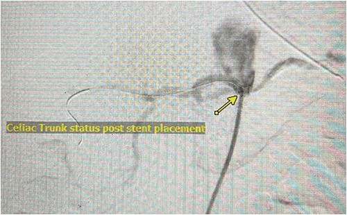 Angiography demonstrating flow through celiac trunk status post stent placement.