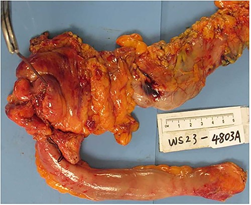 Gross specimen showing thickened terminal ileum with cecal perforation.