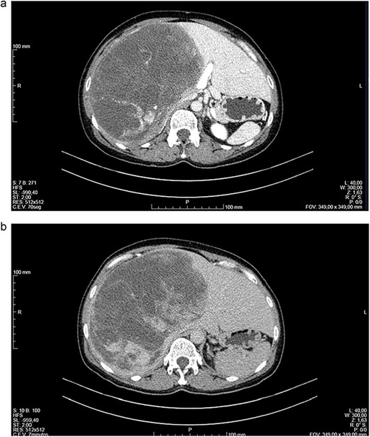 (a, b) Computed tomography (CT) scans of a woman aged 49 years with undifferentiated embryonal sarcoma of the liver. Liver of increased dimensions due to the presence of voluminous oval mass and well-defined limits occupying practically the entire right lobe (measures 16 × 16 × 20 cm3). It is a heterogeneous mass, with areas of apparently liquid spontaneous density. Captures contrast gradually and progressively.
